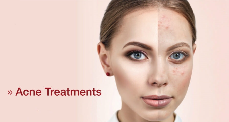 Effective Acne Treatments