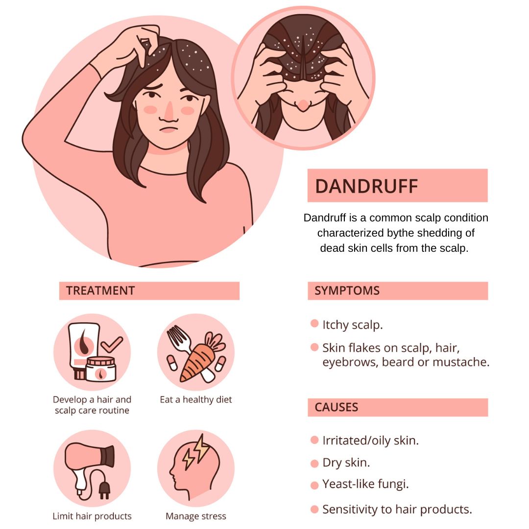 Over-the-Counter Treatments for Dandruff