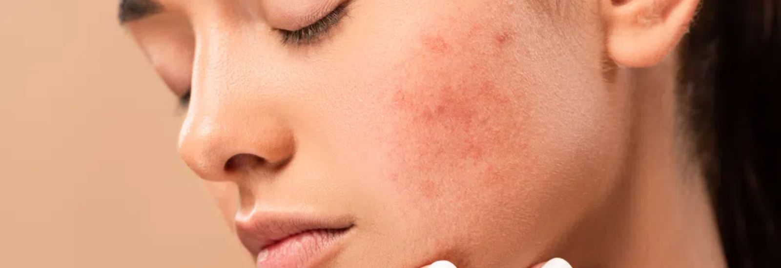 Hormonal Acne Treatment